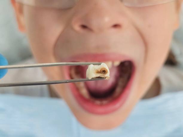 Best Emergency Dental Care for Abscessed Tooth in Carrollton, AL