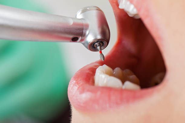 Best Broken or Cracked Tooth Emergency Dentist in Carrollton, AL